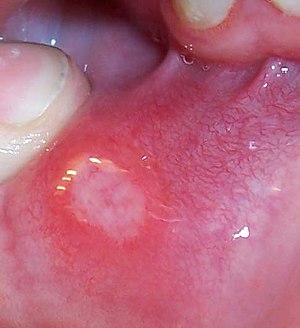 Syphilis mouth sores