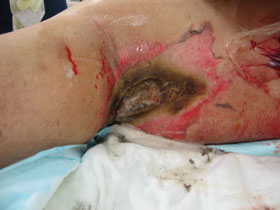 High voltage electrical injuries