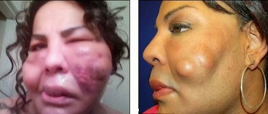 Transgender woman before and after surgery