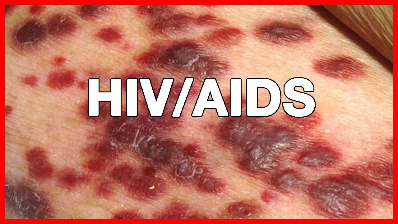 aids symptoms Hiv