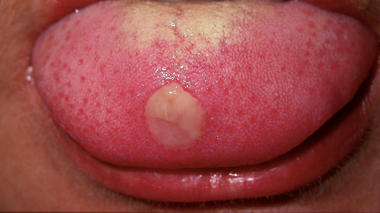 Syphilis on tongue