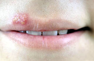 What does mouth herpes look like