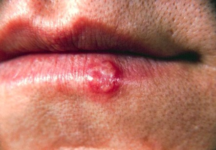 What does mouth herpes look like