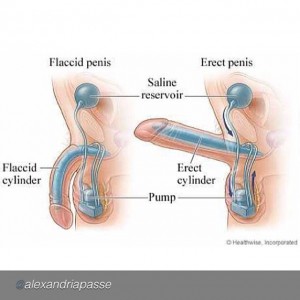 Male penis implant