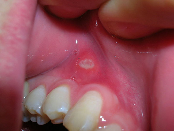 Mouth ulcer canker sores